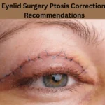 Double Eyelid Surgery Ptosis Correction Post Op Recommendations