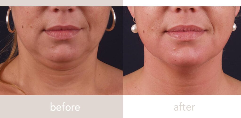 Double Chin Removal in Dubai