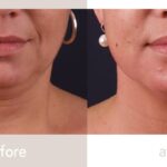 Double Chin Removal in Dubai